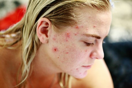 Frauengesicht von der Seite mit Akne Narben auf der Haut